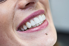 Aligner Schienen - unsichtbare Zahnspange - Beispiel