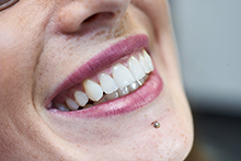 Aligner Schienen - unsichtbare Zahnspange - ohne